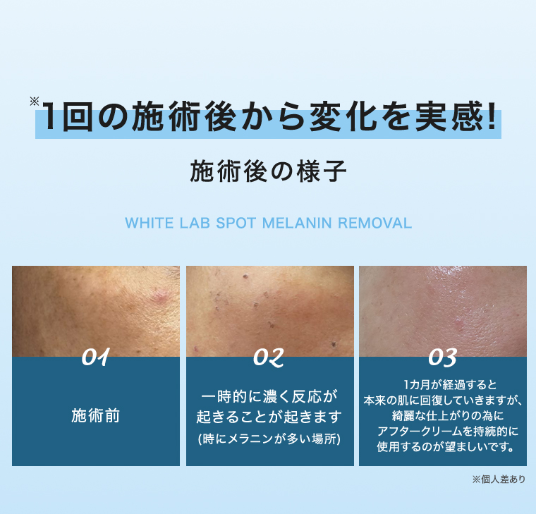 1回の施術後から効果を実感